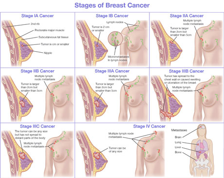 Stages of Breast Cancer