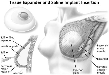 Tissue Expander